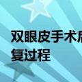 双眼皮手术后的4个恢复期 双眼皮手术后的恢复过程